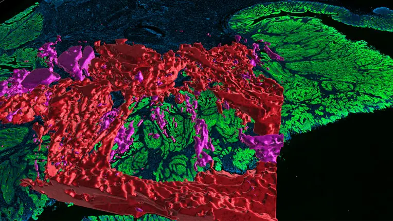 Mapa del cáncer de colon Mapa del cáncer de colon