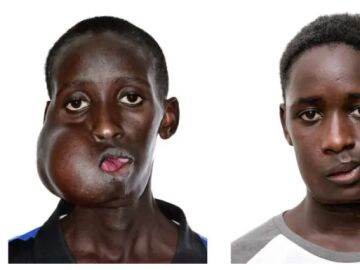 Antes y después de la operación de Mamadou Seydou, un adolescente de 15 años con un tumor facial de más de 20 centímetros