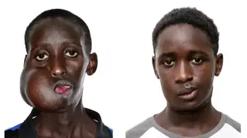 Antes y después de la operación de Mamadou Seydou, un adolescente de 15 años con un tumor facial de más de 20 centímetros