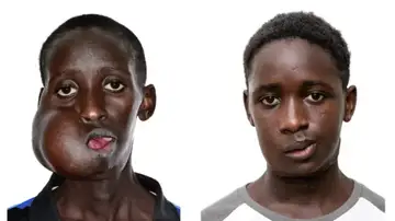 Antes y después de la operación de Mamadou Seydou, un adolescente de 15 años con un tumor facial de más de 20 centímetros Antes y después de la operación de Mamadou Seydou, un adolescente de 15 años con un tumor facial de más de 20 centímetros