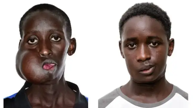 Antes y despu&eacute;s de la operaci&oacute;n de Mamadou Seydou, un adolescente de 15 a&ntilde;os con un tumor facial de m&aacute;s de 20 cent&iacute;metros