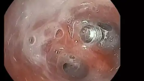 Imagen del tornillo que la mujer había aspirado Imagen del tornillo que la mujer había aspirado