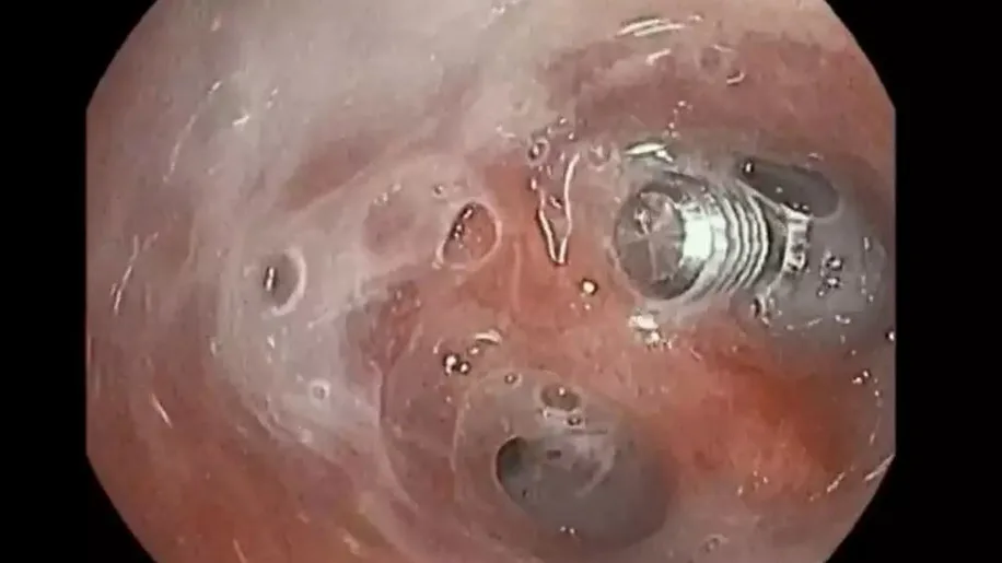 Imagen del tornillo que la mujer había aspirado Imagen del tornillo que la mujer había aspirado