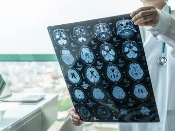 Un médico analiza una resonancia del cerebro Un médico analiza una resonancia del cerebro