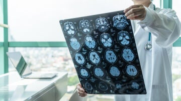 Un médico analiza una resonancia del cerebro