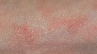 Sarna Sarna