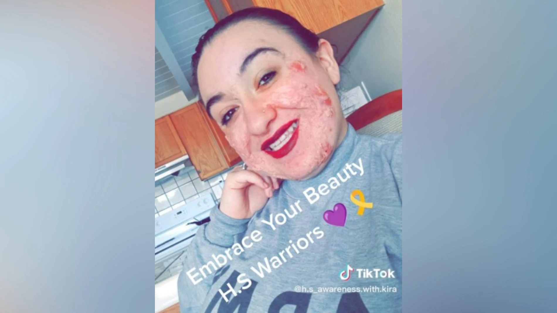 Kira Archuleta, la joven con la enfermedad en la piel Kira Archuleta, la joven con la enfermedad en la piel