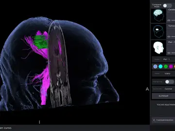 Técnica de fluorescencia para mejorar la detección y eliminación de las células tumorales