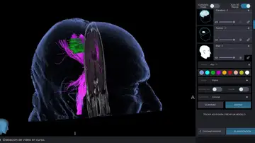 Técnica de fluorescencia para mejorar la detección y eliminación de las células tumorales Técnica de fluorescencia para mejorar la detección y eliminación de las células tumorales