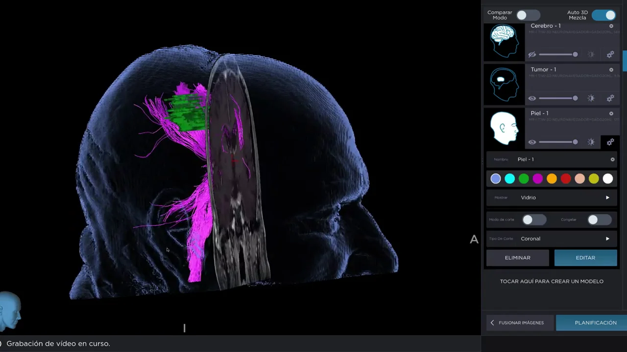 Técnica de fluorescencia para mejorar la detección y eliminación de las células tumorales Técnica de fluorescencia para mejorar la detección y eliminación de las células tumorales
