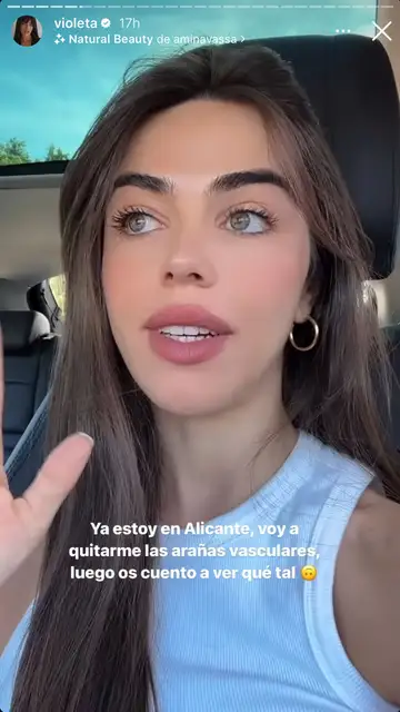 Violeta se quita las arañas vasculares Violeta se quita las arañas vasculares