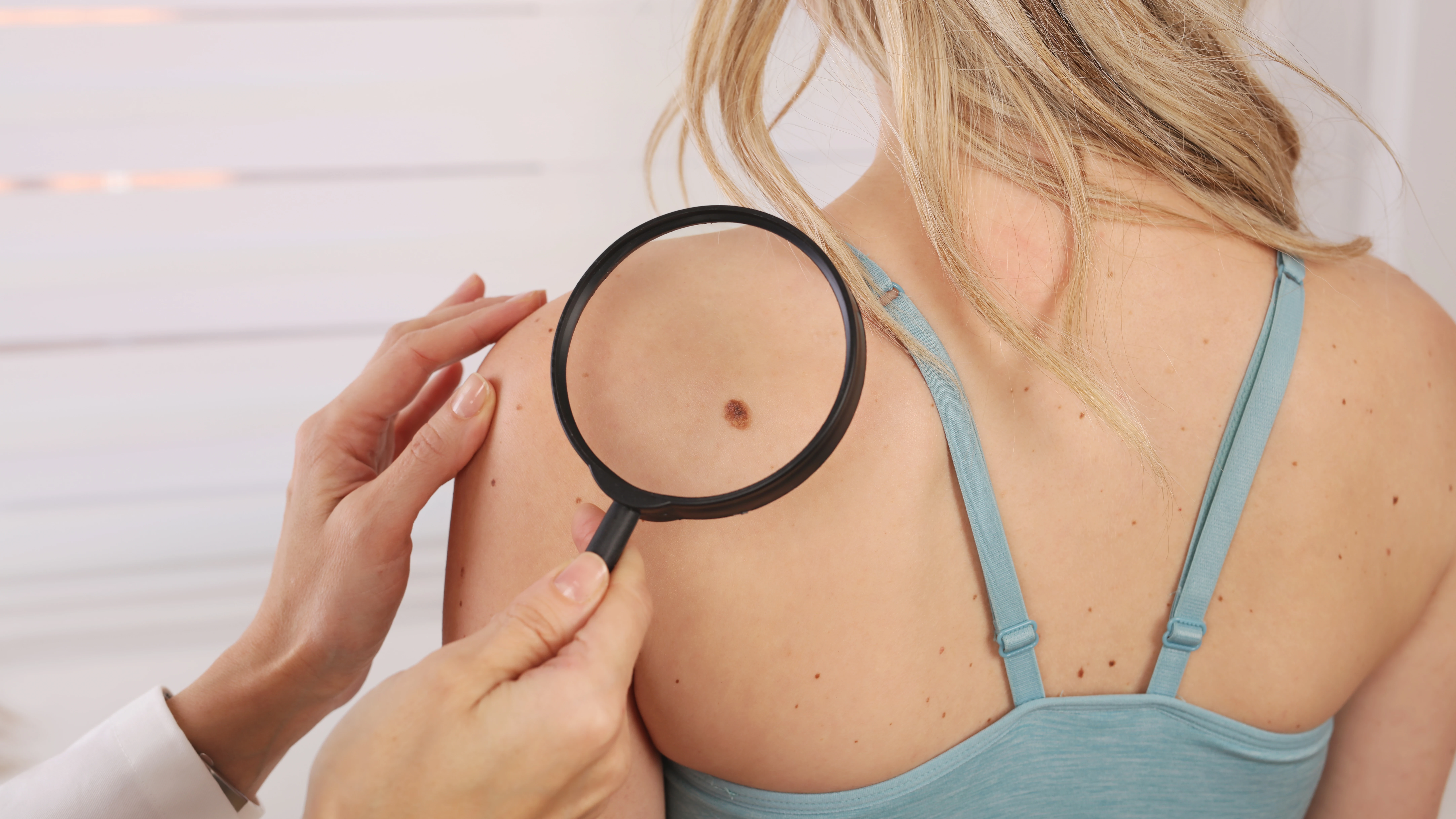 Doctora examinando con lupa el lunar de una paciente Doctora examinando con lupa el lunar de una paciente