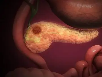 Cáncer de páncreas Cáncer de páncreas
