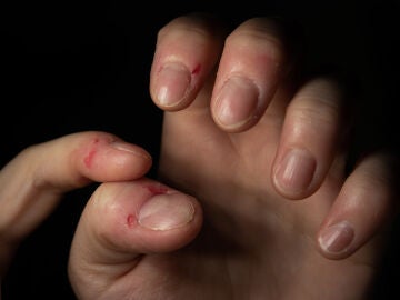 Plano detalle de uñas mordidas y con heridas en los dedos