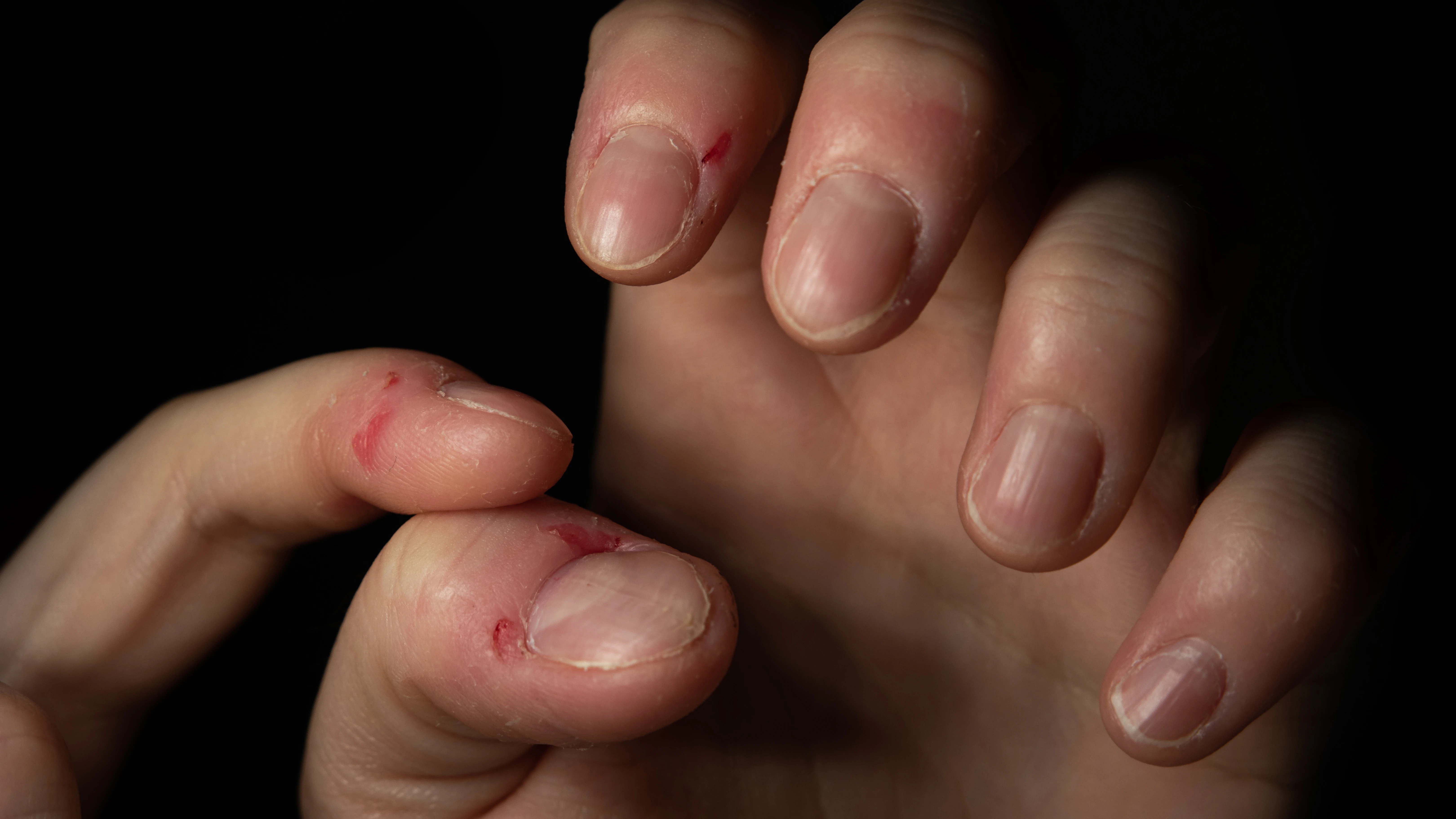Plano detalle de u&ntilde;as mordidas y con heridas en los dedos