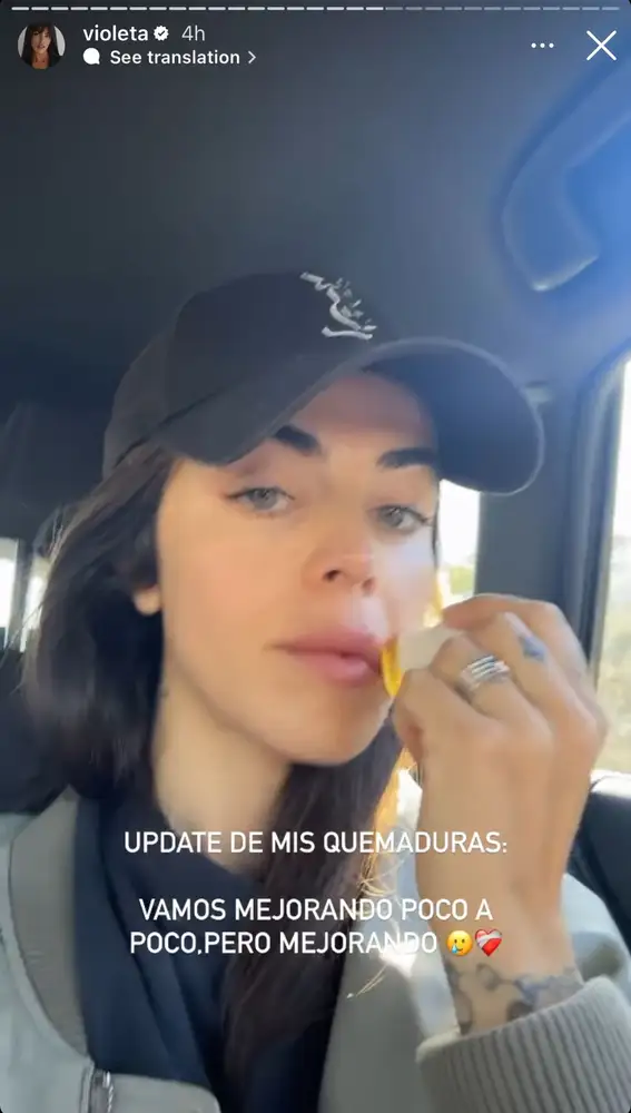 Violeta Mangriñán hace un update de sus quemaduras