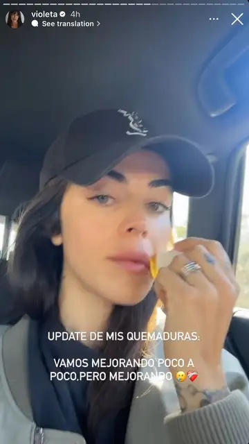 Violeta Mangriñán hace un update de sus quemaduras Violeta Mangriñán hace un update de sus quemaduras