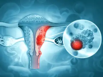 Cáncer de Ovario Cáncer de Ovario
