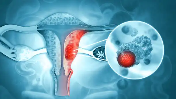 Cáncer de Ovario Cáncer de Ovario