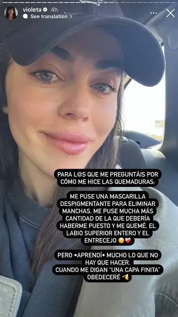 Violeta Mangriñán explica cómo se hizo las quemaduras Violeta Mangriñán explica cómo se hizo las quemaduras
