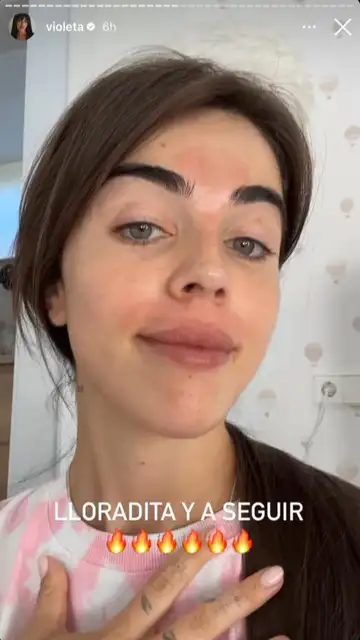 Violeta Mangriñán se quema la cara Violeta Mangriñán se quema la cara