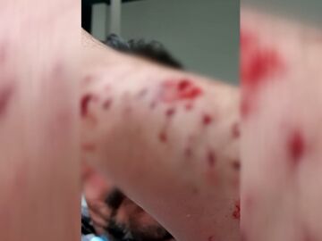 Imagen de las heridas provocadas por el pitbull
