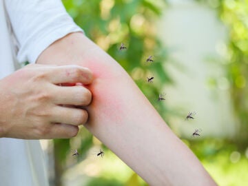 Un hombre se rasca la picadura de un mosquito en el brazo