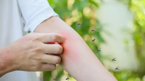 Un hombre se rasca la picadura de un mosquito en el brazo Un hombre se rasca la picadura de un mosquito en el brazo