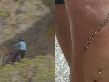 El momento en el que Cam McCaul se rompe la tibia y el estado de su pierna