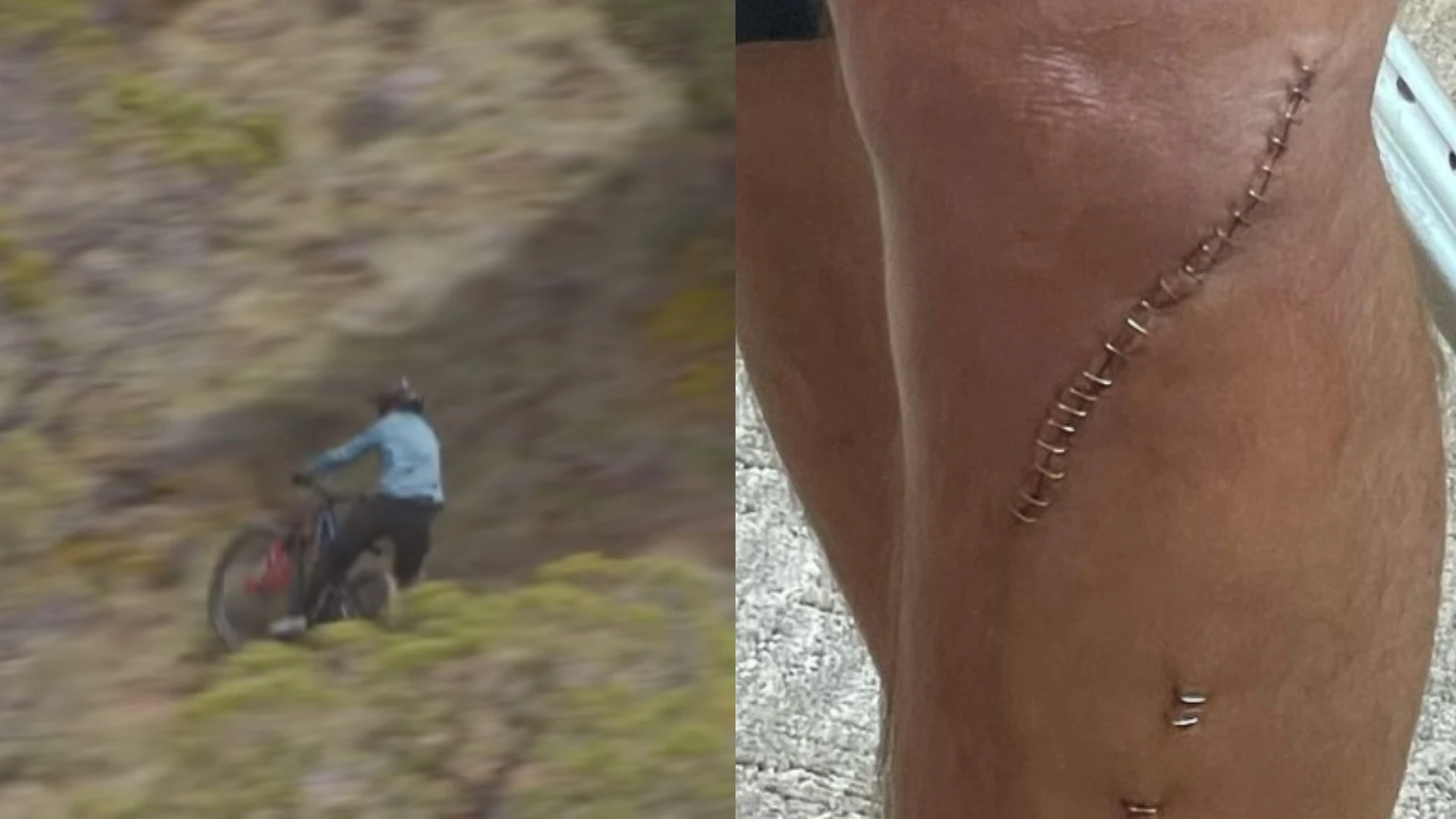El momento en el que Cam McCaul se rompe la tibia y el estado de su pierna