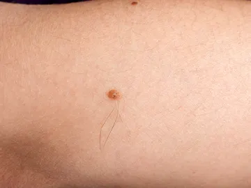 Lunar con pelos Lunar con pelos