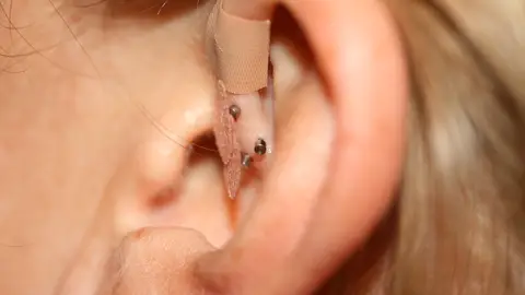 Auriculoterapia Auriculoterapia