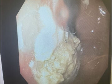 Imagen del 'bezoar' en el estómago del niño