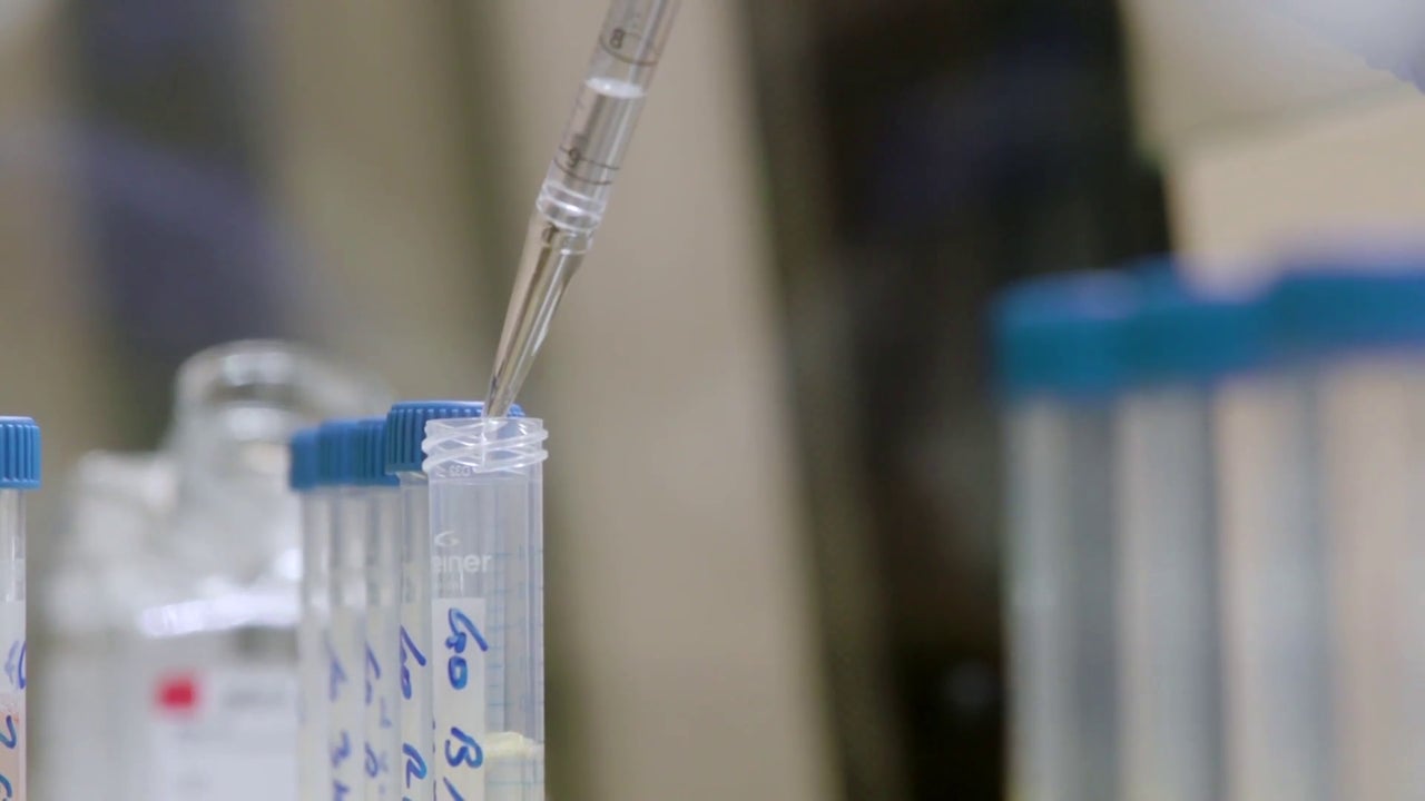 Researchers at Sant Pau Hospital identify a new gene that causes ALS, which is key to its diagnosis. Researchers at Sant Pau Hospital identify a new gene that causes ALS, which is key to its diagnosis.