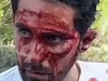 El rostro de Alberto Contador tras caerse en China El rostro de Alberto Contador tras caerse en China