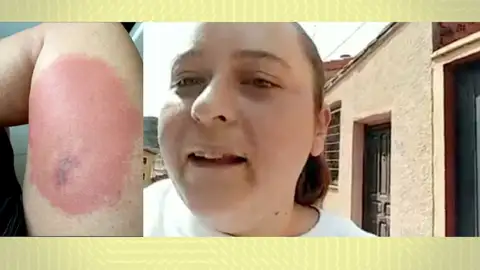 Picadura de mosquito. Picadura de mosquito.