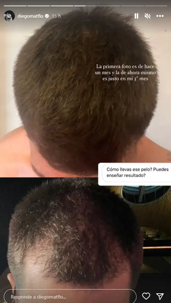 Diego Matamoros actualiza a sus seguidores sobre su injerto de pelo
