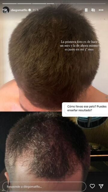Diego Matamoros actualiza a sus seguidores sobre su injerto de pelo