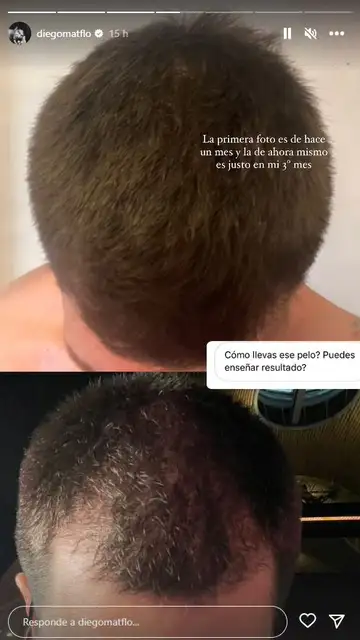 Diego Matamoros actualiza a sus seguidores sobre su injerto de pelo Diego Matamoros actualiza a sus seguidores sobre su injerto de pelo