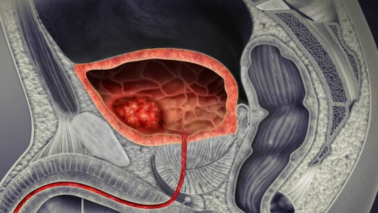 Ilustraci&oacute;n 3D de un c&aacute;ncer de vejiga