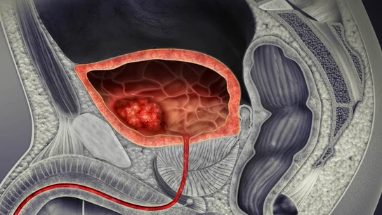Ilustración 3D de un cáncer de vejiga Ilustración 3D de un cáncer de vejiga