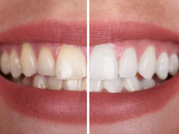Manchas en los dientes Manchas en los dientes