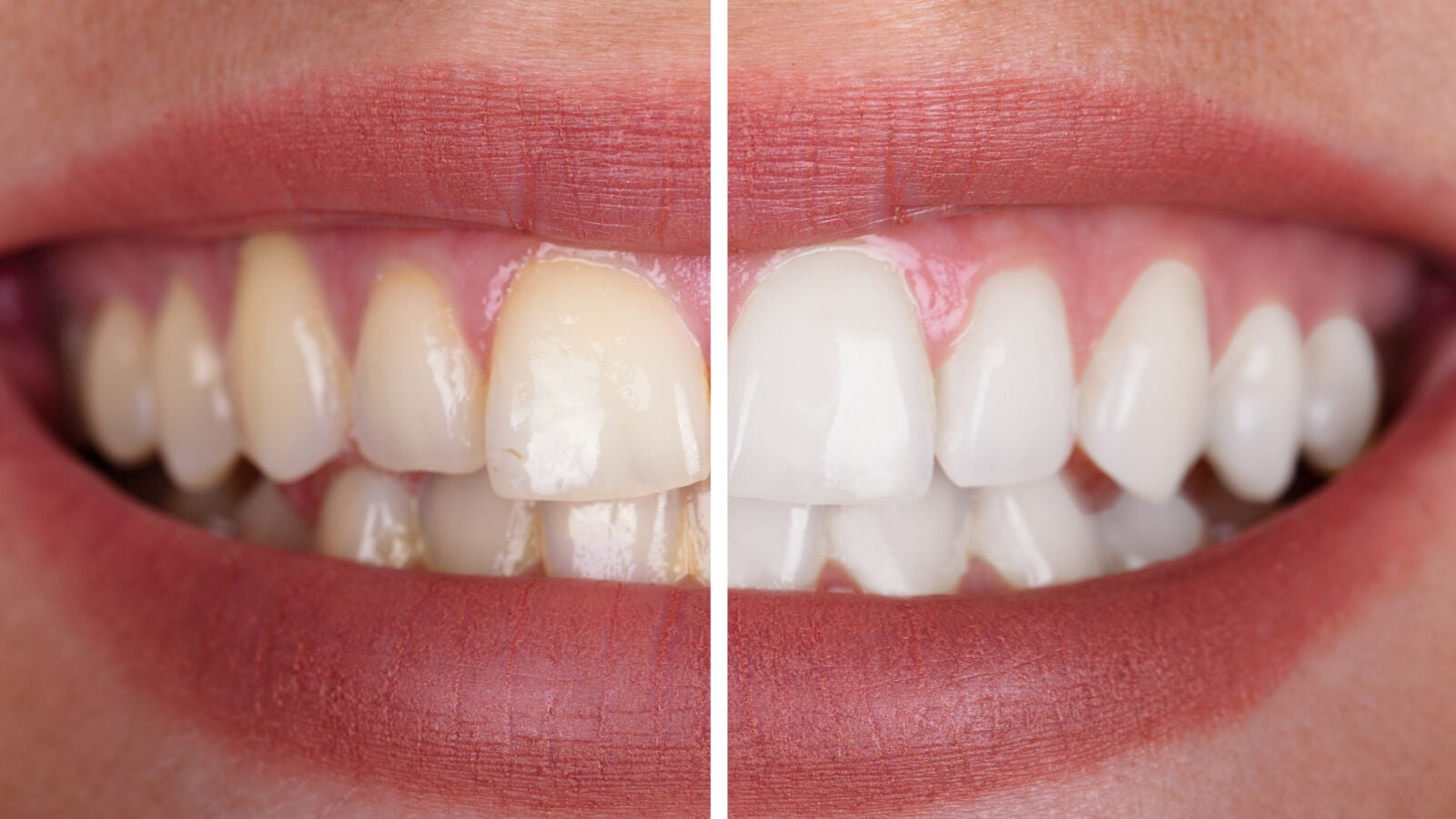Manchas en los dientes: ¿Cómo evitar que aparezcan?