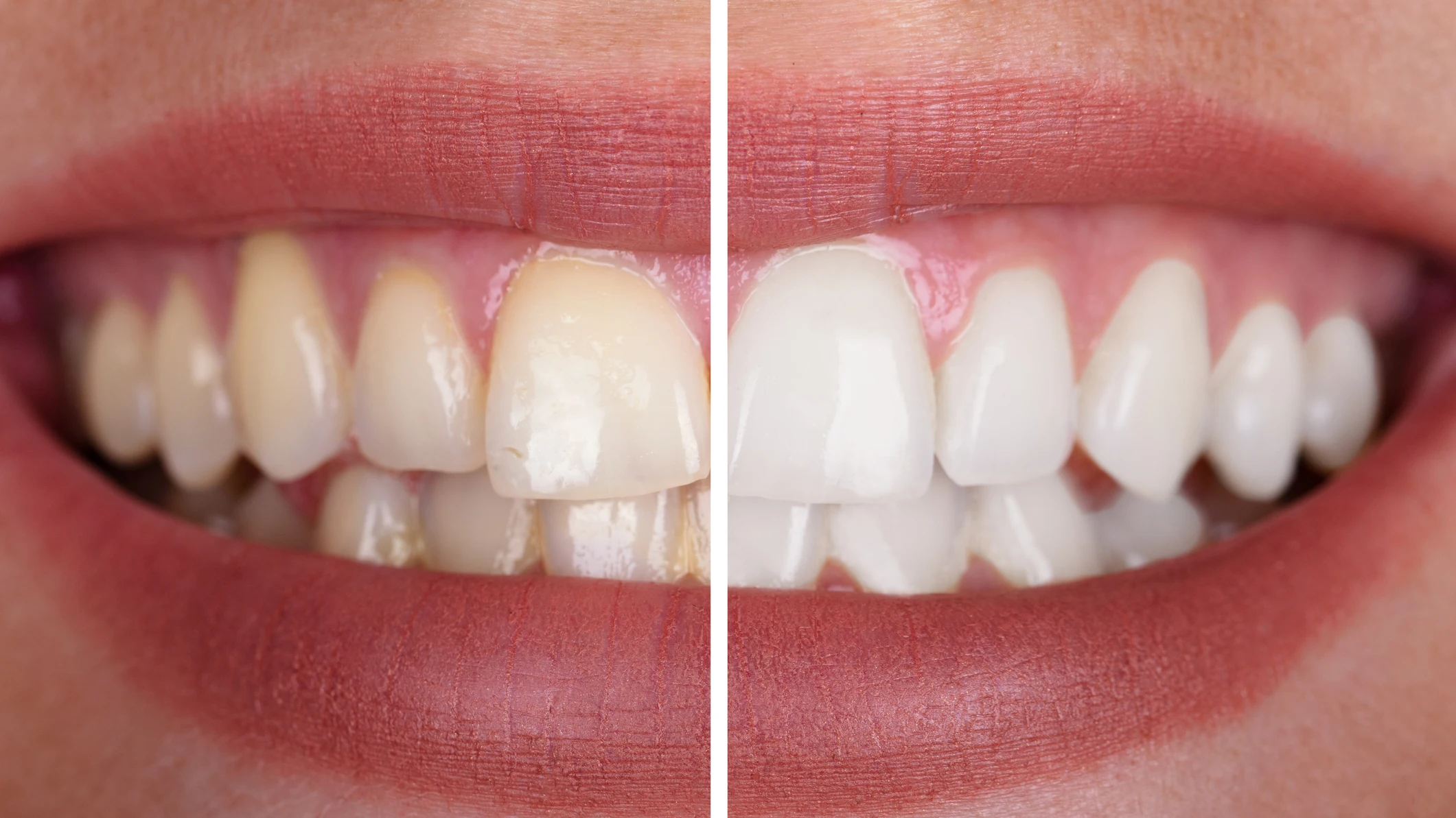 Manchas en los dientes Manchas en los dientes