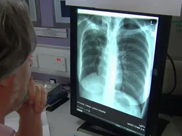 Un estudio español aumenta en un 20% la supervivencia al cáncer de pulmón Un estudio español aumenta en un 20% la supervivencia al cáncer de pulmón
