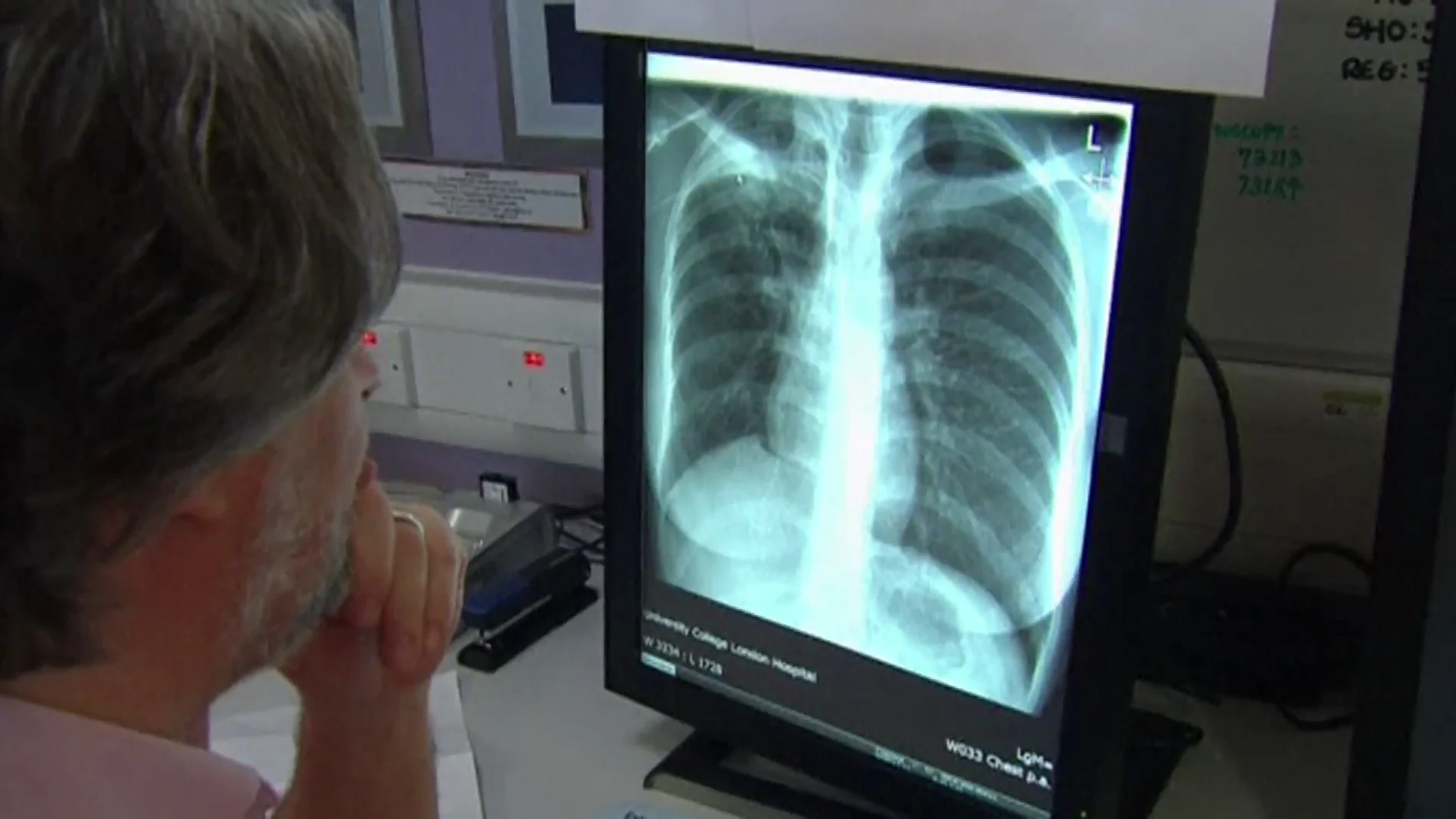 Un estudio español aumenta en un 20% la supervivencia al cáncer de pulmón