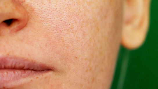 Melasma