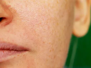 Melasma Melasma
