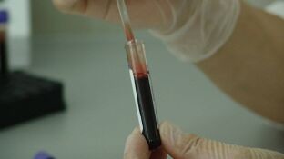 Demuestran la eficacia de una nueva inmunoterapia frente al mieloma multiple resistente