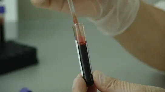 Demuestran la eficacia de una nueva inmunoterapia frente al mieloma multiple resistente Demuestran la eficacia de una nueva inmunoterapia frente al mieloma multiple resistente